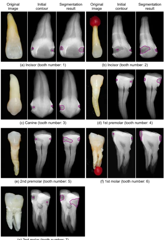Fig.  4.  The  dental  cavities  of  the  7  tooth  phantoms  are  segmented  from  the  7  tooth  phantoms  after  being  applied  edge-based  active  contour  algorithm