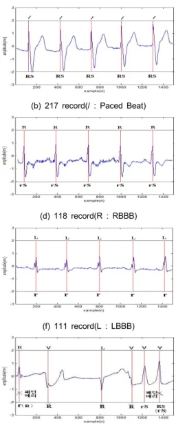 Fig. 6 Result of QRS pattern detection