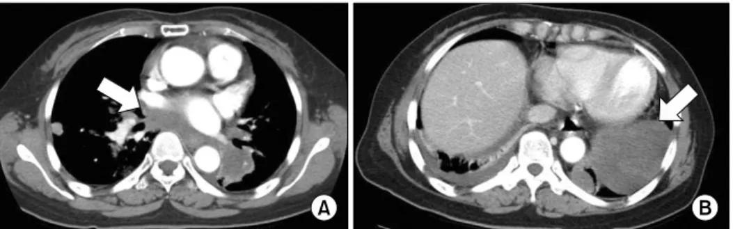 Figure 6. The histopathologic finding of femur bone. The bone lesion is composed of metastatic adenocarcinoma, which is similar to the carcinoma component of the  ute-rus  cancer