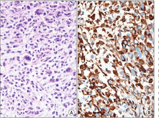 Figure  7.  The  histopatho- histopatho-logic  finding  of   percuta-neous  biopsy  of  peripheral  lung  mass