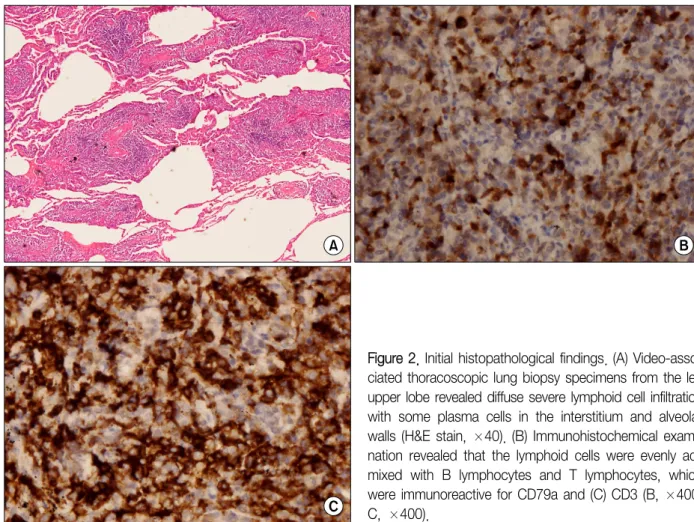 Figure 2. Initial histopathological findings. (A) Video-asso- Video-asso-ciated thoracoscopic lung biopsy specimens from the left upper lobe revealed diffuse severe lymphoid cell infiltration with  some  plasma  cells  in  the  interstitium  and  alveolar 