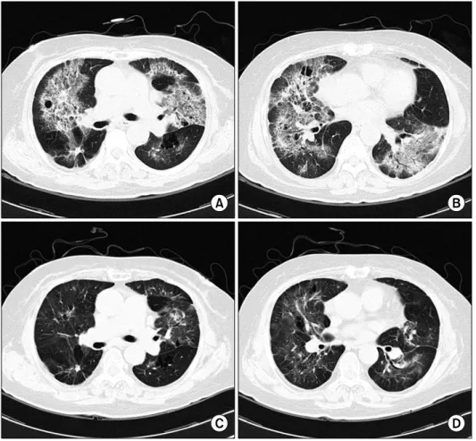 Figure 3. Radiographic find- find-ings of second episode. (A, B)  Initial  chest  computed  tomography  (CT)  scan   re-vealed diffuse bilateral  gro-und-glass opacity with fine reticulation,  traction   bronchi-ectasis  and  consolidative   le-sion
