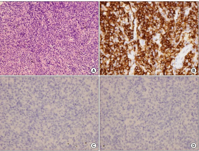 Figure  5.  Histopathological  findings  of  third  episode.  (A)  Histological  examination  of  percutaneous  lung  needle  biopsy specimens  revealed  marked  infiltration  of  lymphoid  cells  (H&amp;E  stain,  ×200)