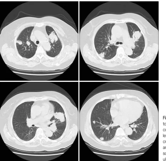 Figure 1. Simple chest radiograph shows a large irregular mass-like lesion in the left upper lobe with multiple  opac-ities  in  both  lungs.