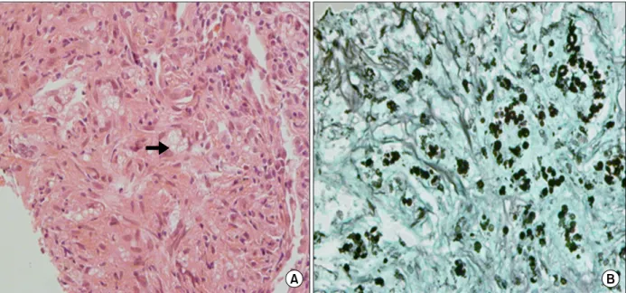 Figure  3.  Histologic  findings  of  percutaneous  computed  tomography-guided  biopsy  from  mass  in  the  left  upper  lobe