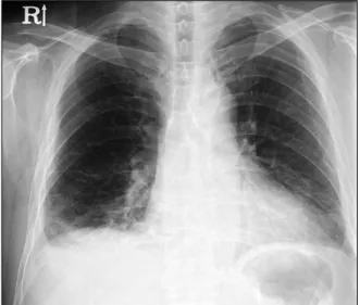 Figure 1. Chest x-ray shows ill-defined density in the right lower  lung  with  blunted  costophrenic  angle.