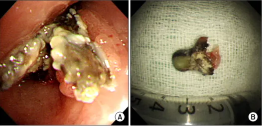 Figure  2.  A  32-year-old  woman's  bronchoscopy  image and extracted  bron-choliths