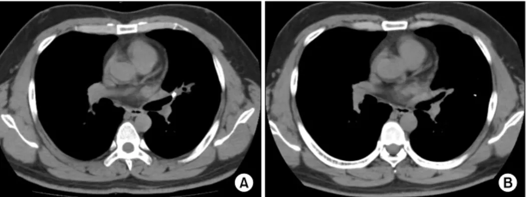 Figure  3.  A  32-year-old  man's  computed  tomography  (CT)  scan  image.  (A)  Chest  CT  scan  image  (mediastinal  setting)  showing patchy opacities surrounding lingular segment and a calcified density within left upper lobe bronchus suggesting bronc