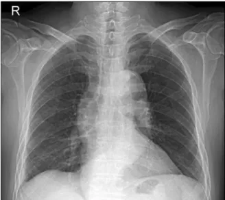 Figure  3.  Abdominal  com- com-puted  tomography  shows  long segmental edematous wall  thickening  in  the   ce-cum (white arrow) and  ter-minal  ileum  (black  arrow).