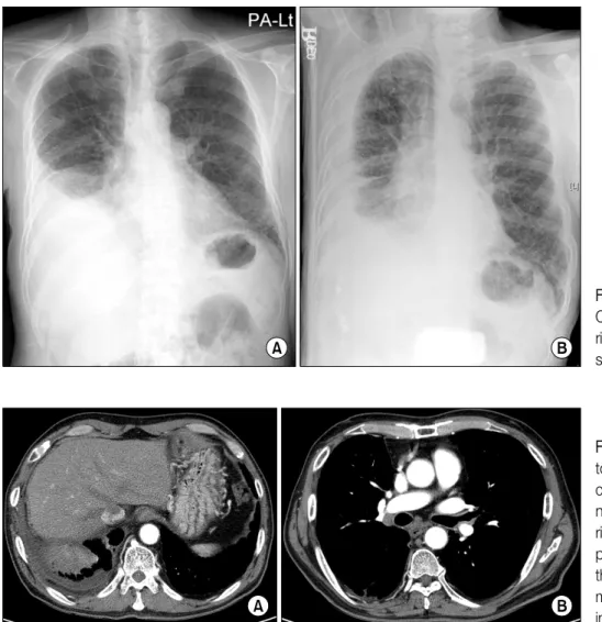 Figure  1.  Chest  X-ray. 