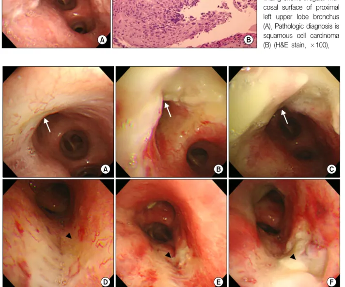 Figure  3.  Bronchoscopic  and  pathologic  findings  at initial  visit.  Bronchoscopic  finding shows irregular  mu-cosal  surface  of  proximal  left  upper  lobe  bronchus  (A)