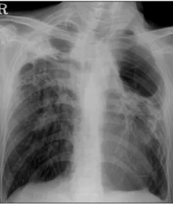 Figure 1. The initial chest X-ray showing destroyed lung lesions.  Multifocal  cystic  lesions  and  consolidations  are  also  seen.