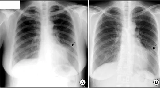 Figure 2.  Chest  HRCT  im- im-ages  taken  during  the  first  visit revealed small nodules and branching centrilobular  opacities in the left lingular segment  (A),  RML  (B,  C)  and  consolidation   contain-ing air bronchogram in the left lingular segm