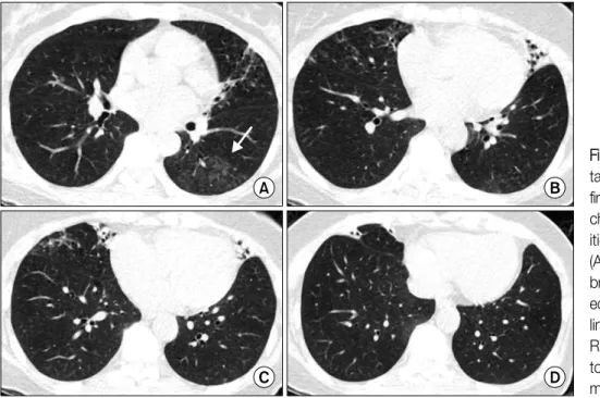 Figure 3. Chest CT images  taken  12  months  after  the  first visit showed new  bran-ching  centrilobular   opac-ities  in  the  left  lower  lobe  (A,  arrow)  and  persitent  bronchiolitis  and   bronchi-ectatic  features  in  the  left  lingular  segm