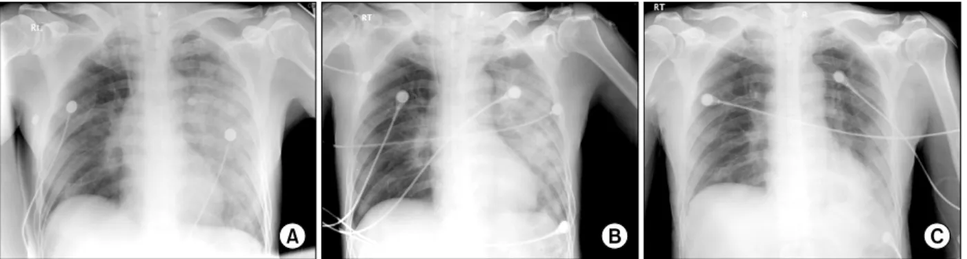 Figure  1.  Serial  change  of  patient's  chest  radiogram.  (A)  Initial  x-ray  in  the  emergency  room  shows  an  infiltration  in left lung, right upper lung and right lower lung