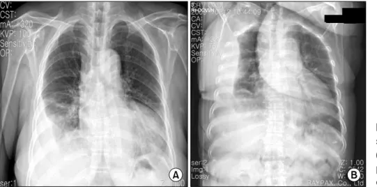 Figure 2. Initial chest X-ray shows right pleural effusion (A) and shifting of the right pleural  effusion in the right  decubitus  view  (B)