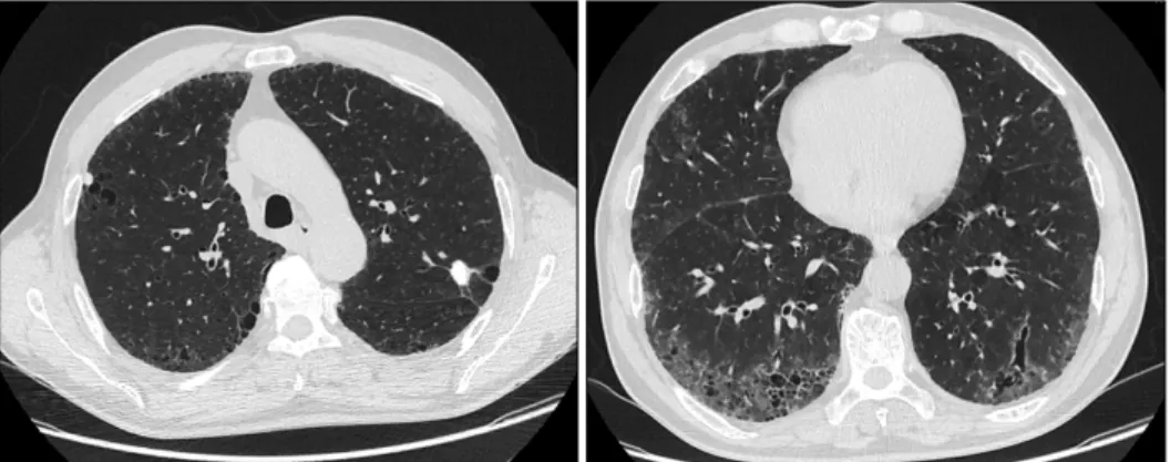 Figure 2. High resolution computed tomography shows peripheral ground-glass attenuation with multiple clustered air-fil- air-fil-led  cysts  in  the  both  lower  lung  zones  and  paraseptal  emphysema  in  both  upper  lung  zones
