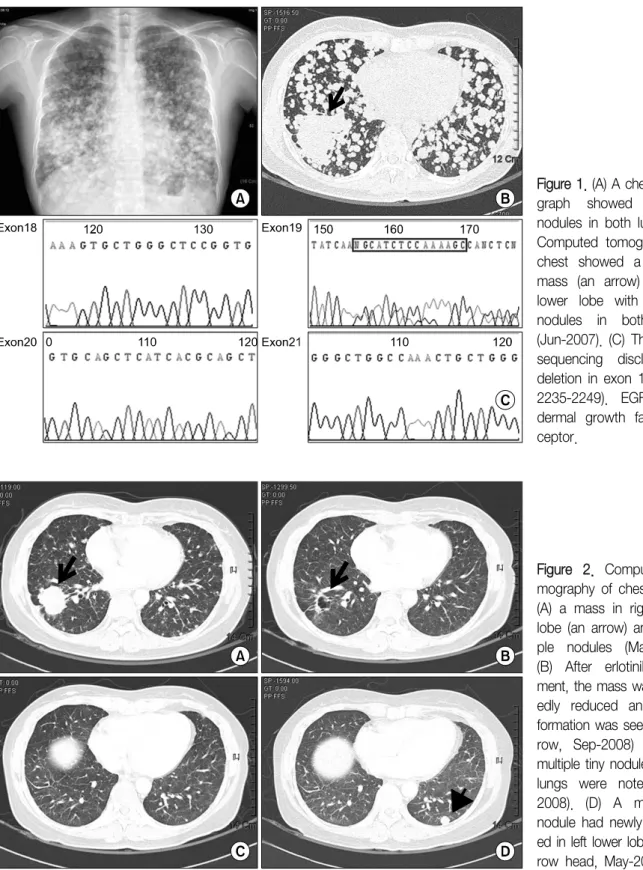 Figure  2.  Computed  to- to-mography  of  chest  shows  (A)  a  mass  in  right  lower  lobe  (an  arrow)  and   multi-ple  nodules  (May-2008)