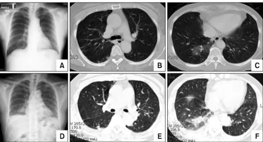 Figure  1.  Chest  PA  view  and  chest  CT.  (A)  Chest  PA  at  a  local  clinic  shows  no  active  lung  lesion