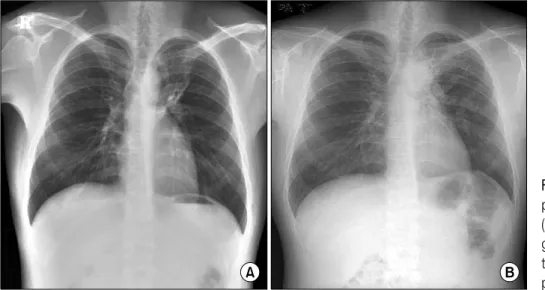 Figure 1. (A) Chest PA was  performed  8  monthe  ago. 