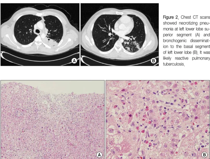 Figure 3. Pathologic findings showed lobular hepatitis presenting severe necroinflammatory activity with perivenular con- con-fluent necrosis (A, H&amp;E stain, ×100), prominent eosinophilic infiltration and loose periportal fibrosis (B, H&amp;E stain, ×40
