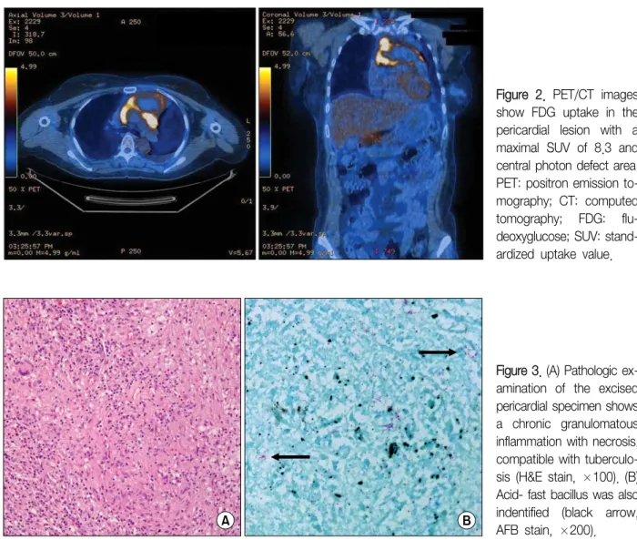 Figure  2.  PET/CT  images  show  FDG  uptake  in  the  pericardial  lesion  with  a  maximal  SUV  of  8.3  and  central photon defect area.