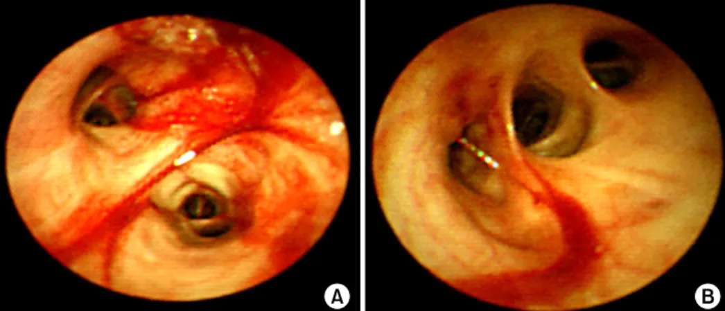 Figure 3. Bronchoscopic fin- fin-dings.  Bronchoscope   sho-ws  mucosal  edema,  flush,  bleeding  in  left  upper  lobe  (LUL) bronchus (A) and  rig-ht  middle  lobe  (RML)  and  right lower  lobe  (RLL)   bro-nchus  (B).
