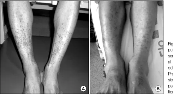 Figure  2.  (A)  Multiple  pur- pur-puric  skin  lesions  are   pre-sented  on  both  lower  legs  at  the  diagnosis  of   Hen-och-Schönlein  purpura