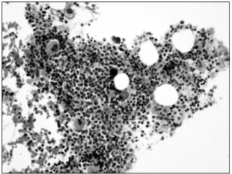Figure  4.  Peripheral  blood  smear  findings.  The  platelet  number  was  markedly  decreased  (Wright-Giemsa  stain,