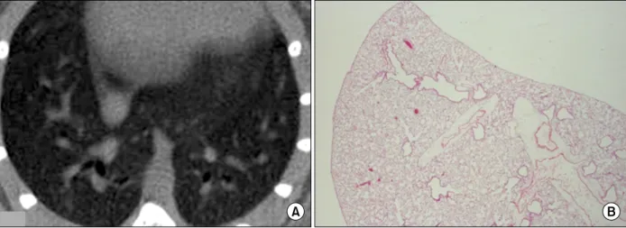 Figure  1.  Micro  CT  finding  (A)  and  pathologic  finding  (B)  of  saline-treated  mice