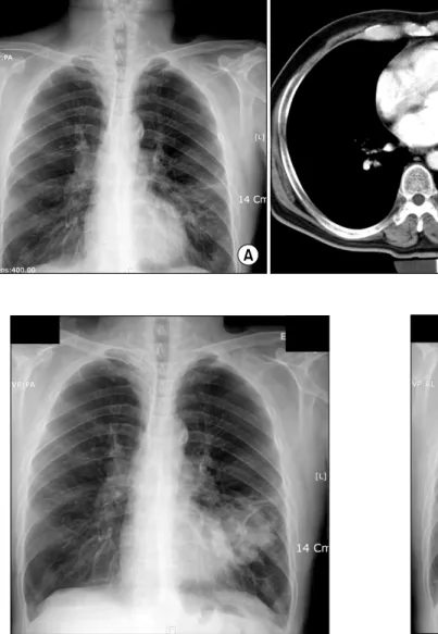 Figure  4.  About  5x6  cm  sized  large  lobulating  nodular  mass with infiltration can be seen at left lower lung field.