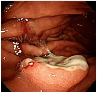 Figure  1.  Initial  gastrofiberscopy  showed  3.2  cm  sized  polypoid  mass  with  ulceration  in  the  body  of  stomach.