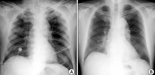 Figure 2. (A) Pre-emboliza- Pre-emboliza-tion,  selective  angiography  of the right bronchial artery shows contrast leakage  in-to  the  right  bronchial   lu-men with parenchymal  pig-mentation