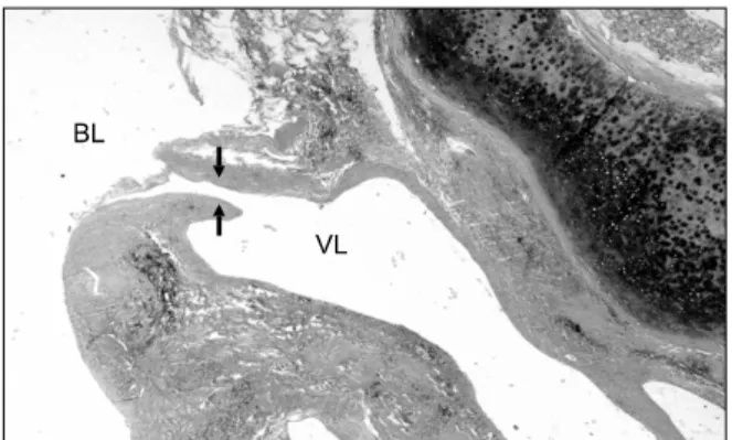 Figure 3. Abnormal, dilated vessel is present in the sub- sub-mucosa beneath the cartilage