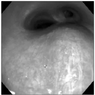 Figure 2. Chest computed tomography of the presented male. There was about 5.6×4.8×7 cm sized, well  de-fined, cystic mass at right subcarinal area