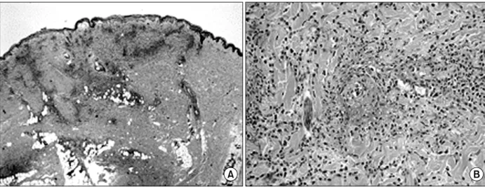 Figure 3. Microscopic findings of skin biopsy. (A) Infiltration of inflammatory cells were seen from the dermis to subcuta- subcuta-neous fat tissue (H&amp;E stain, ×40)