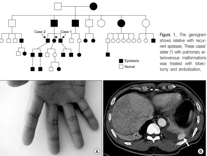 Figure  1.  The  genogram  shows  relative  with   recur-rent epistaxis. These cases' sister (*) with pulmonary  ar-teriovenous  malformations  was  treated  with   lobec-tomy  and  embolization.
