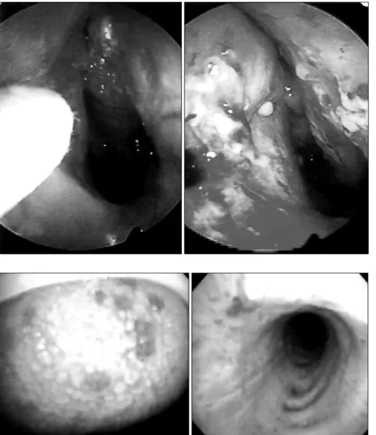 Figure  4.  Nasal  endos- endos-copies  show  epistaxis  and  multiple  telangiectasis  on  both  nasal  cavities.