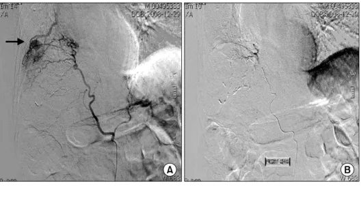 Figure  4.  Disappeared  pseudoaneurysm  of  right  lower  lobe  in  chest  CT  scan  at  10  days  after  embolization.