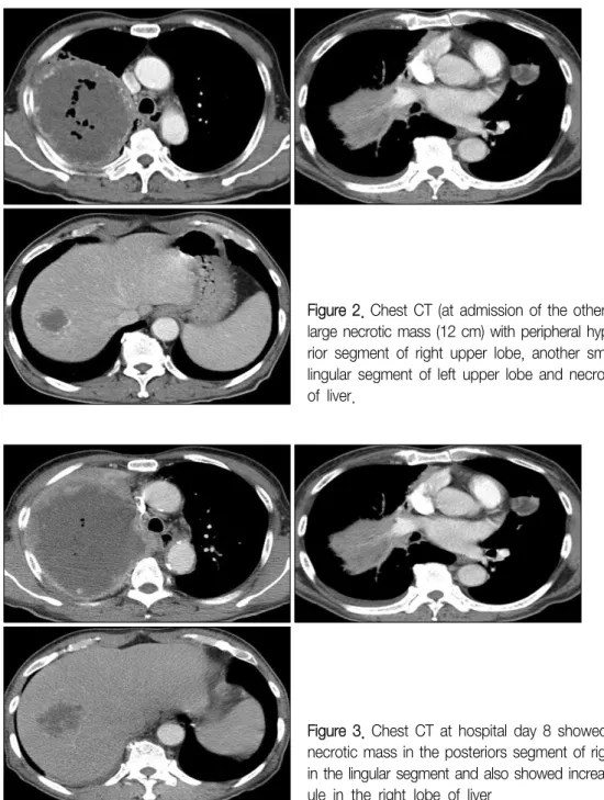Figure  2.  Chest  CT  (at  admission  of  the  other  hospital)  showed  a  huge large necrotic mass (12 cm) with peripheral hypervascularity in the  poste-rior  segment  of  right  upper  lobe,  another  small  necrotic  nodule  in  the  lingular  segmen