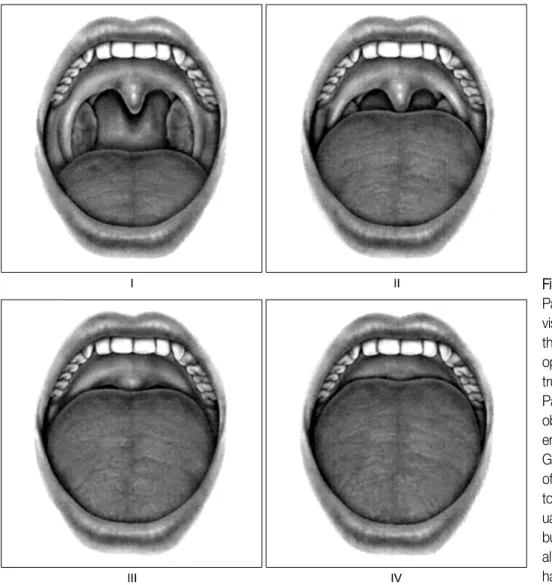 Figure  1.  The  Friedman  Palate Position is based on visualization of structures in the  mouth  with  the  mouth  open  widely  without   pro-trusion  of  the  tongue 26 