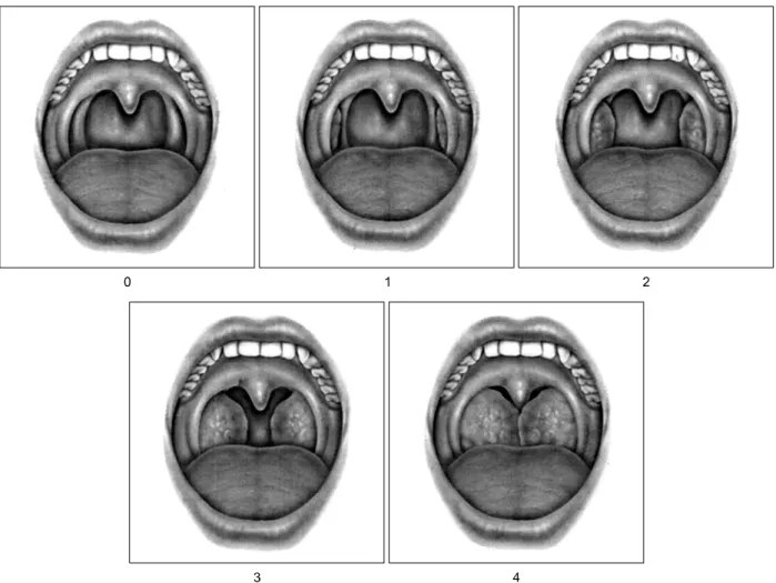 Figure  2.  Tonsil  size  is  graded  from  0  to  4 26 .  Tonsil  size  0  denotes  surgically  removed  tonsils