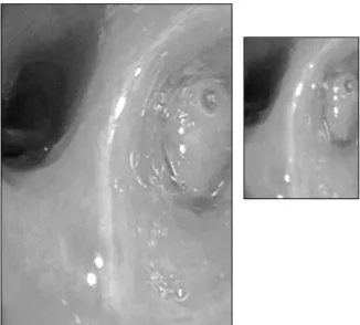 Figure 2. Case  1:  Chest computed  tomography  showed obstructive  bronchitis  with  Bronchiolith  in  RML  (Right  middle  lobe),  lateral  segment.