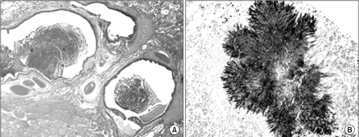 Figure 4. Case 1: Microscopically, (A) the resected lung shows diffuse dilated bronchi or bronchioles containing necrotic material (H&amp;E stain, ×10)