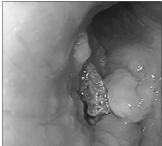 Figure  6.  Case  2:  Bronchoscopy  showed  near  total  ob- ob-struction  of  right  intermedius  branch  with  a  bone  like  material.