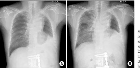 Figure 1. Chest radiograph on  admission  shows  the  left  upper  lobe  mass  and  left  pleural  effusion  (A)