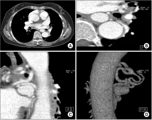 Figure 2. Selective right bronchial angiogram shows bron- bron-chial  artery  hypertrophy  and  huge  bronbron-chial  artery  aneurysm