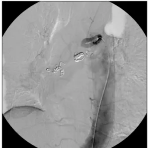 Figure 3. A bronchial artery aneurysm is successfully em- em-bolized with coils at proximal and distal portion of  aneur-ysm  (aneuraneur-ysm  is  not  seen).