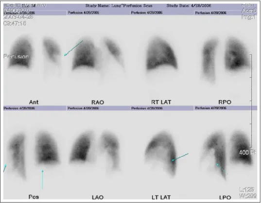 Figure 3.  Lung perfusion scan shows a  large wedge-shaped perfusion defect in left lower  lobe and  another  suspicious perfusion defect in right lower lobe.