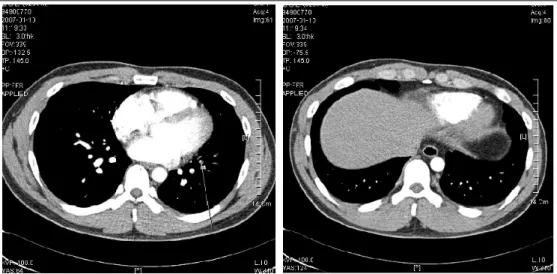 Figure 4.  Chest CT scan after 9 months of anticoagulation therapy, shows small residual thrombi in left lower lobe  (left) and the resolution of the previous wedge-shaped infarction in right lower lobe (right).